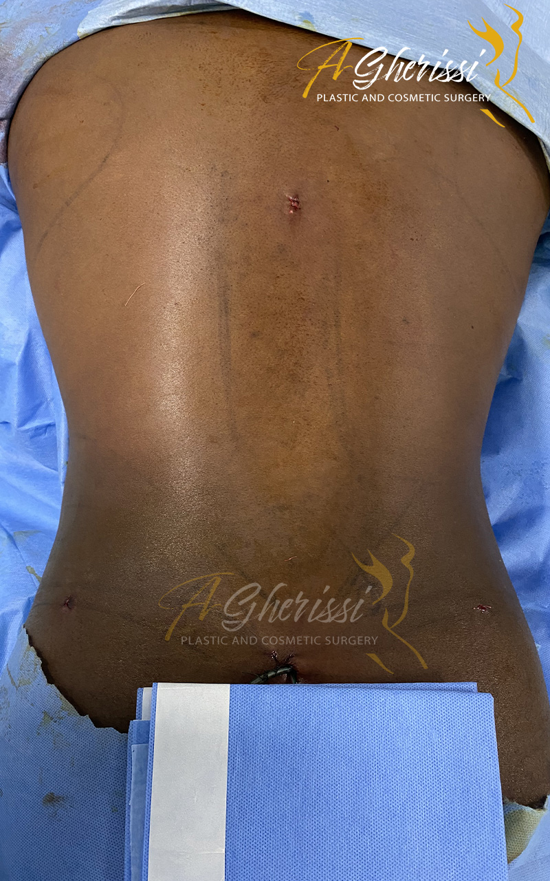 Liposculpture - Sixpack - Après de dos