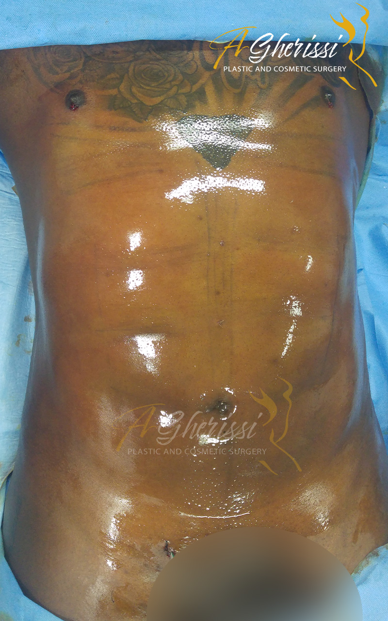 Liposculpture - Sixpack - Après de face