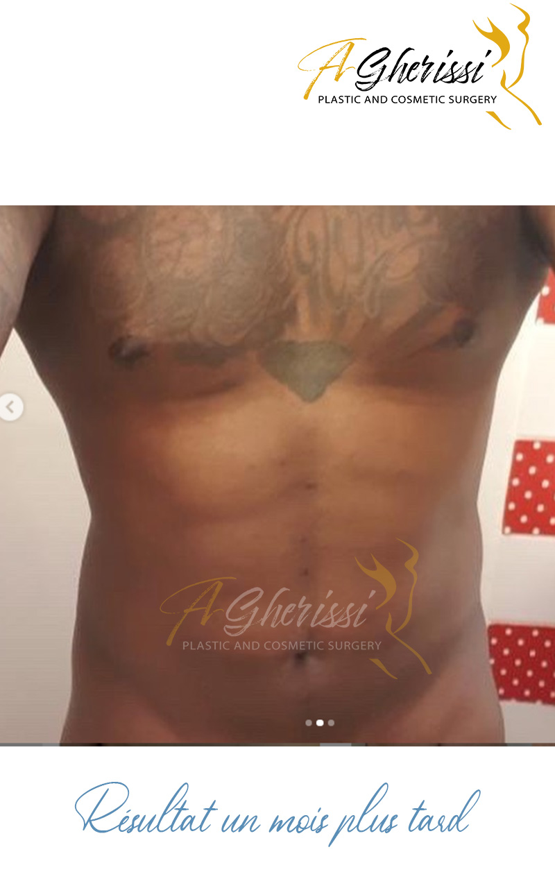 Liposculpture - Sixpack - Après 1 mois