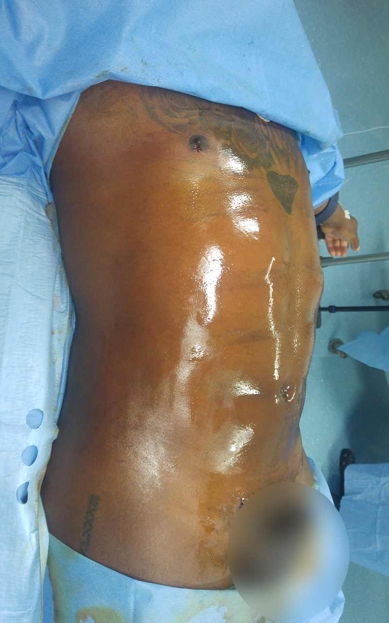 Liposculpture - Sixpack - Après de 3/4