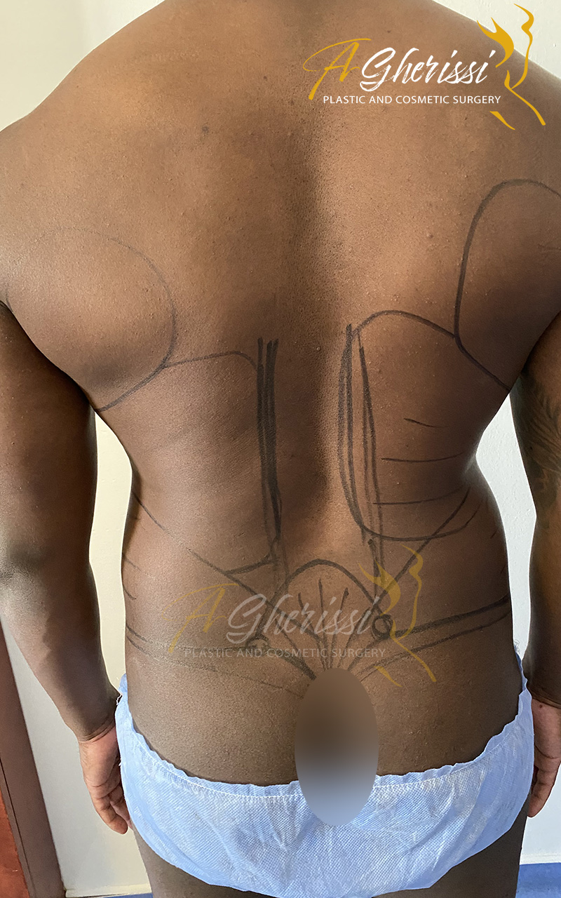Liposculpture - Sixpack - Avant de dos