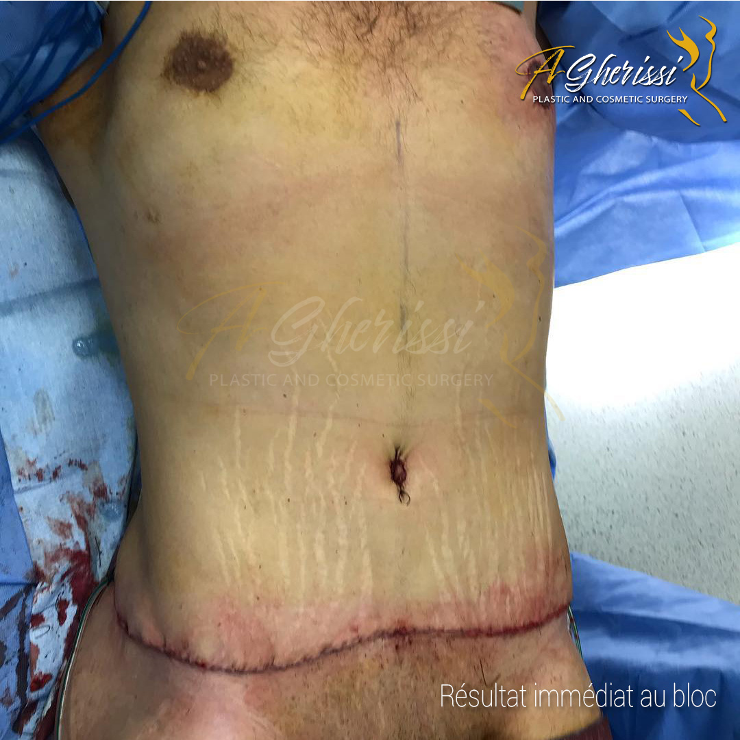 Après - Abdominoplastie homme vue de face
