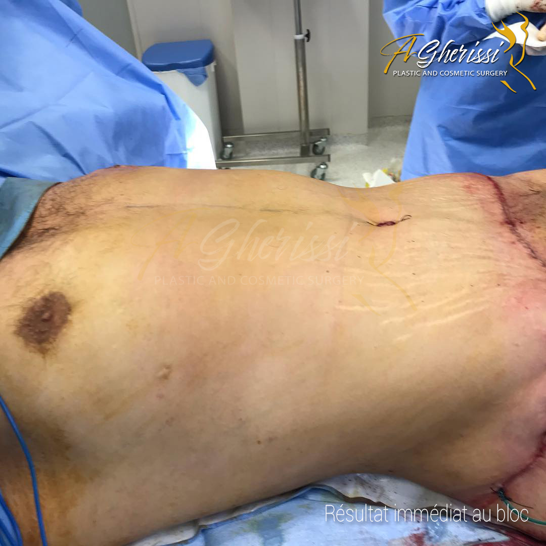 Après - Abdominoplastie homme vue de 3/4