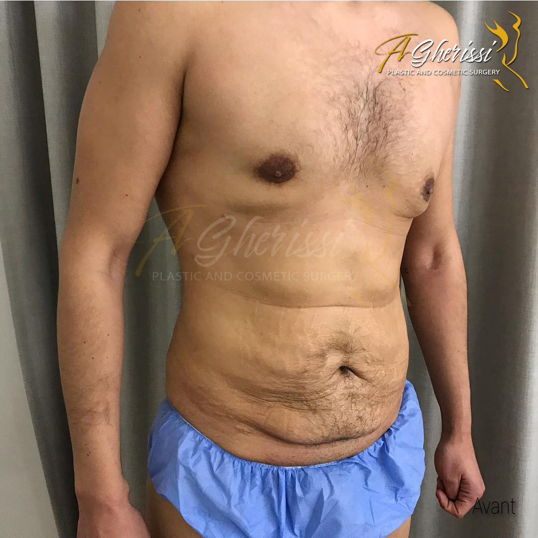 Avant - Abdominoplastie homme vue de 3/4