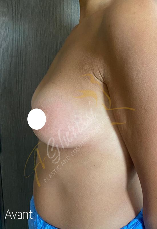 Avant - Augmentation mammaire vue profil gauche