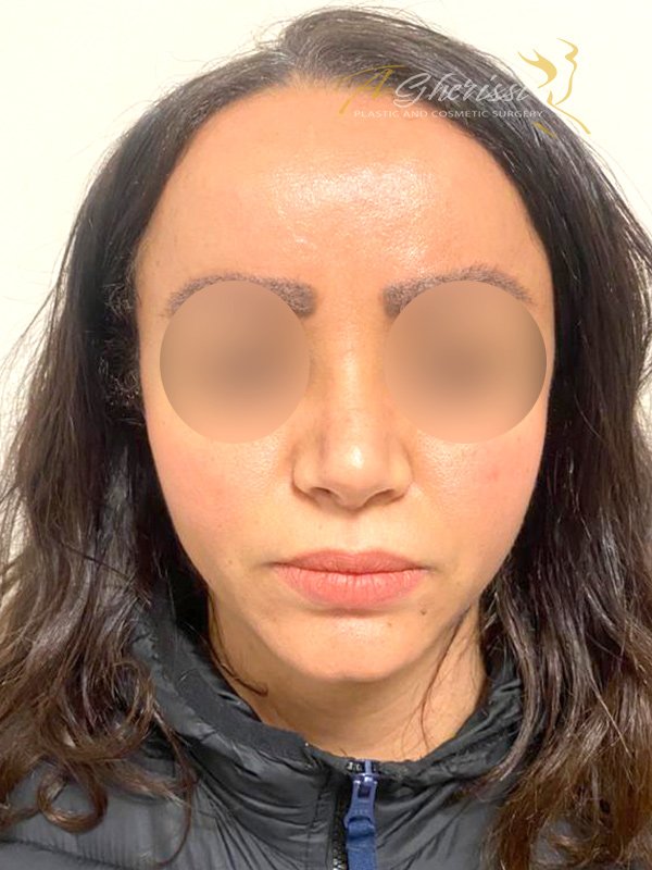 Après - Vue de face
