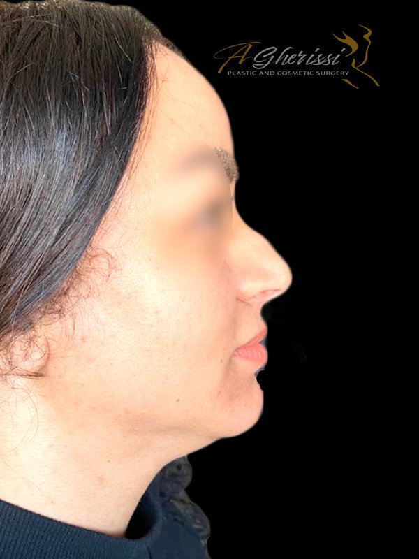 Avant - Vue de profil