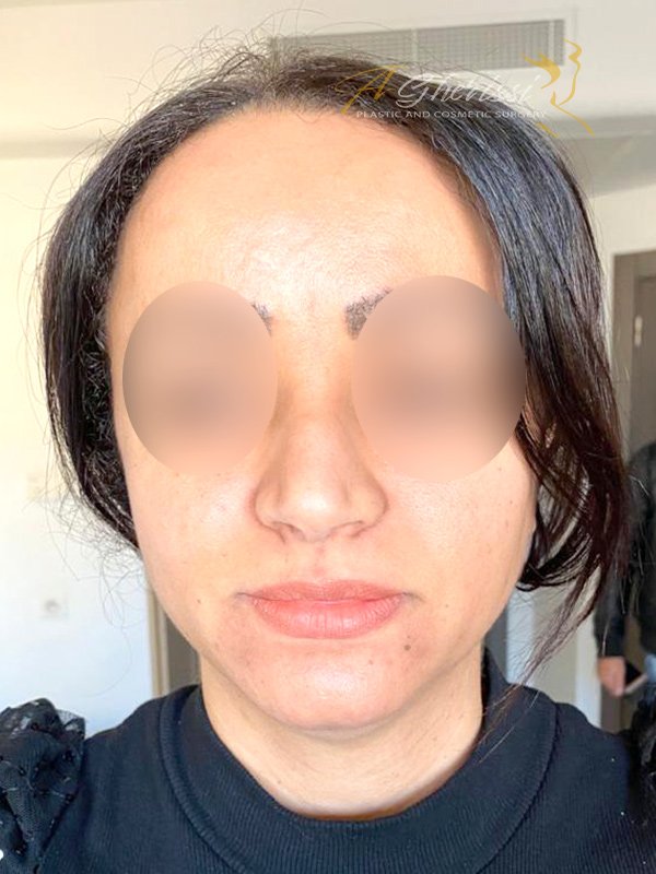 Avant - Vue de face