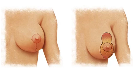 Les techniques d'incision d'une mastopexie