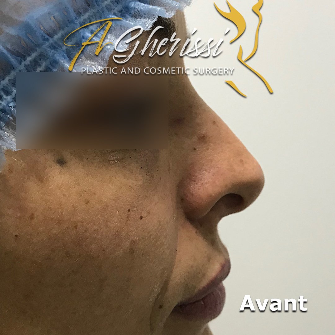 Avant - Vue de profil