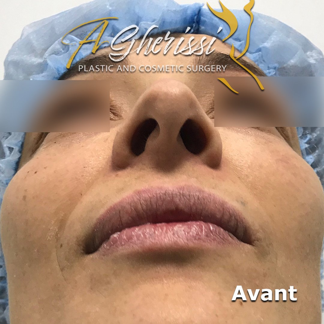 Avant - Vue de face en contre-plongée