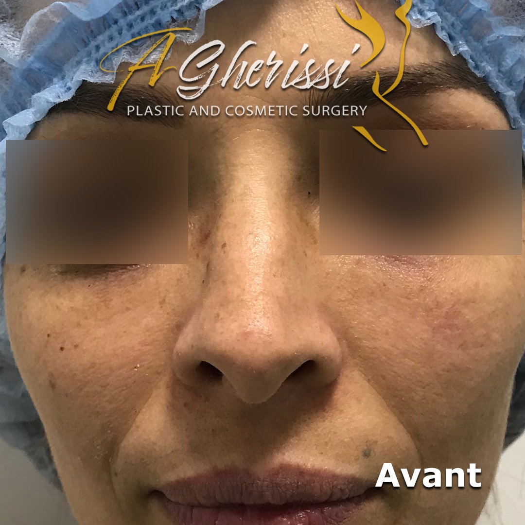 Avant - Vue de face