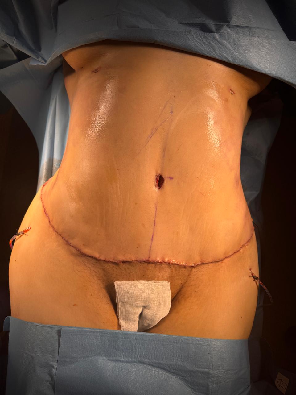 Abdominoplastie étendue et liposuccion 360 - Après 1
