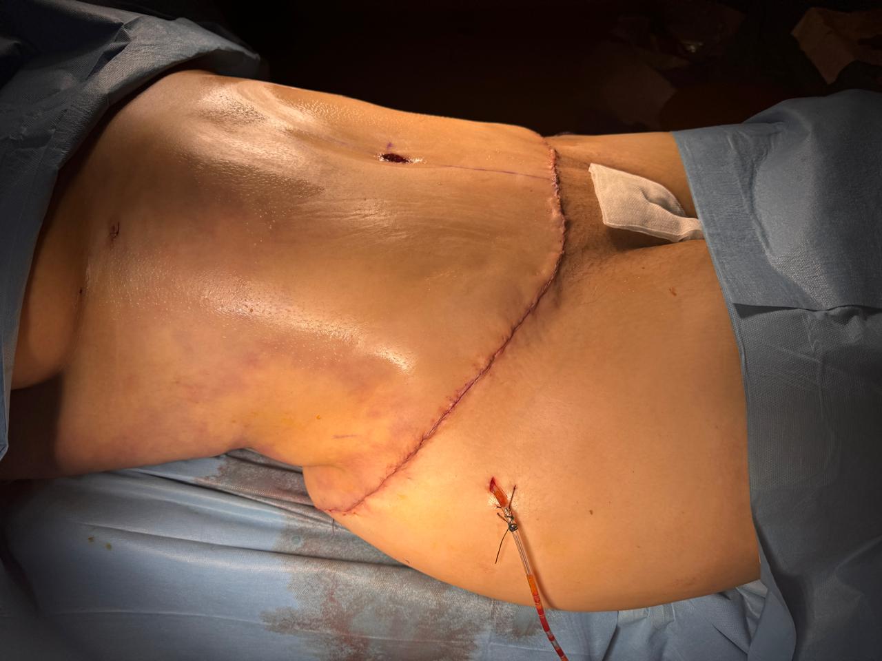 Abdominoplastie étendue et liposuccion 360 - Après 2
