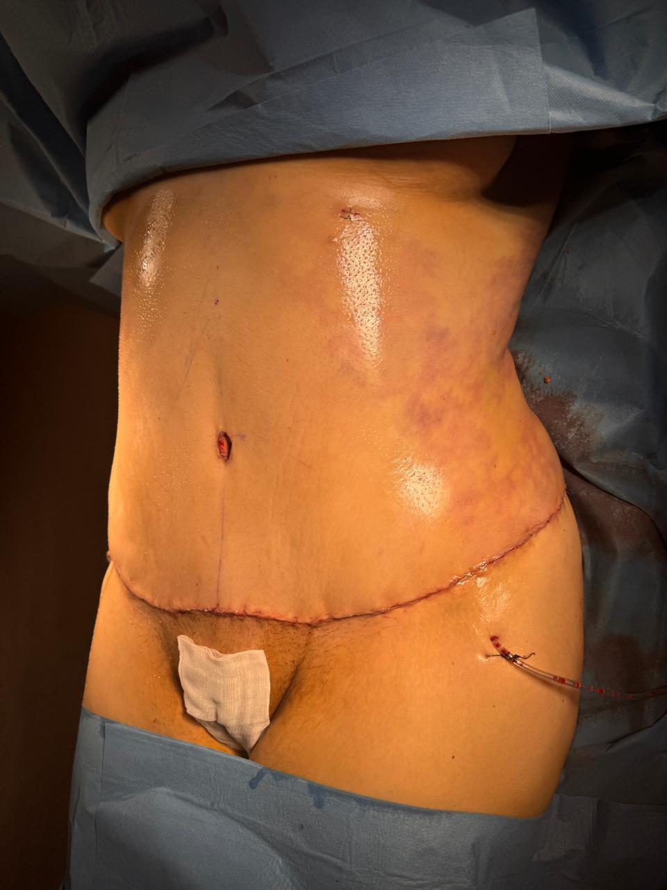 Abdominoplastie étendue et liposuccion 360 - Après 4