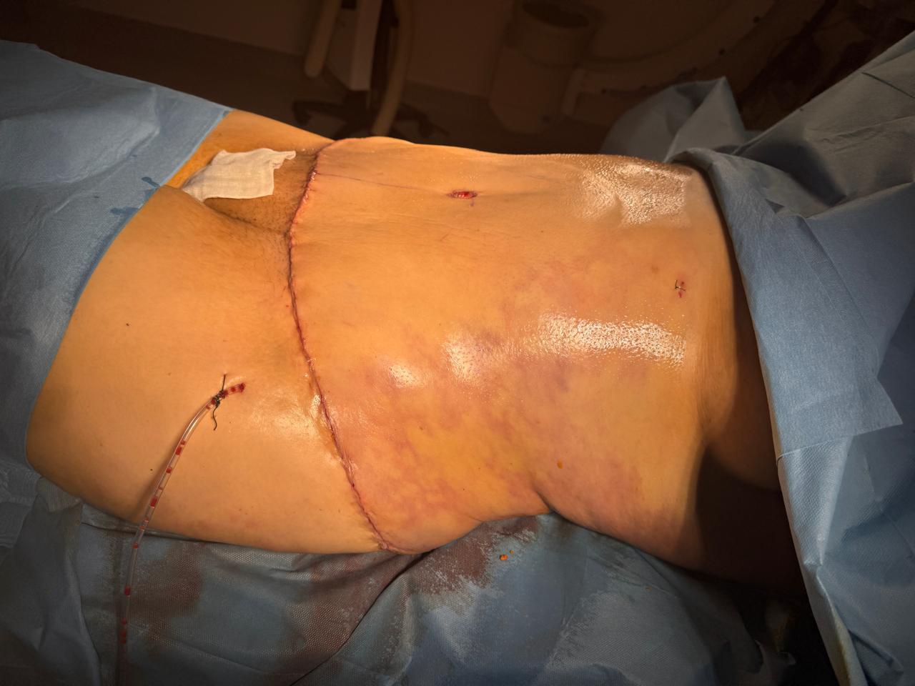 Abdominoplastie étendue et liposuccion 360 - Après 5