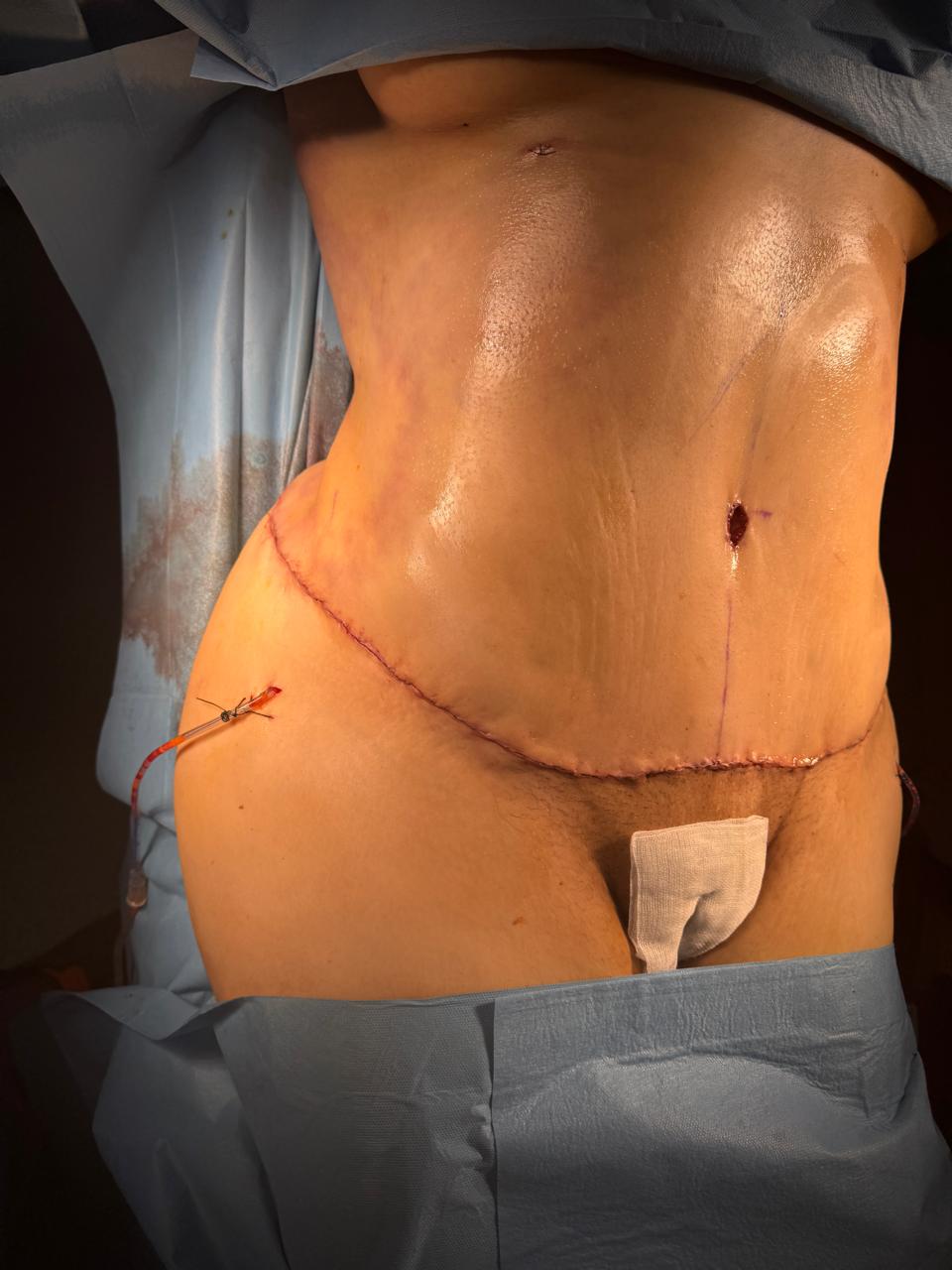 Abdominoplastie étendue et liposuccion 360 - Après 6
