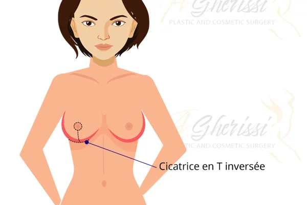 Comment se déroule la chirurgie du lifting des seins ?
