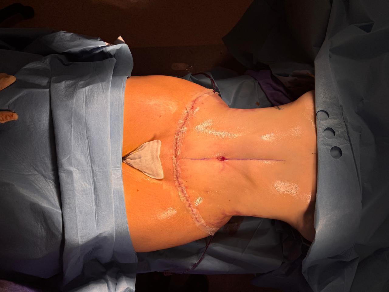 Abdominoplastie + Lipo + BBL - Après 3