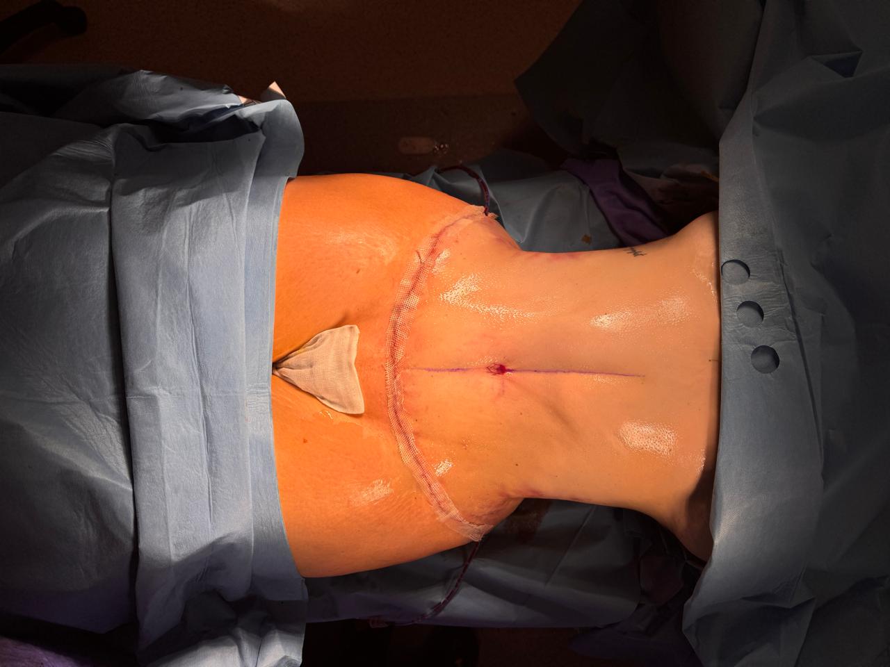 Abdominoplastie + Lipo + BBL - Après 4
