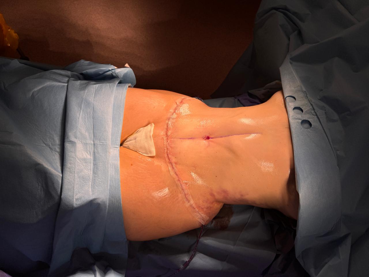 Abdominoplastie + Lipo + BBL - Après 5