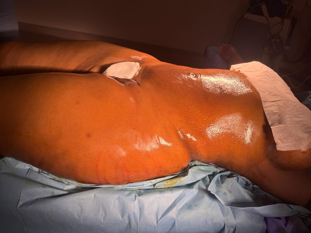 Liposculpture + Renuvion + BBL - Après 1
