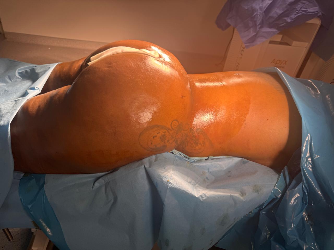 Liposculpture + Renuvion + BBL - Après 5