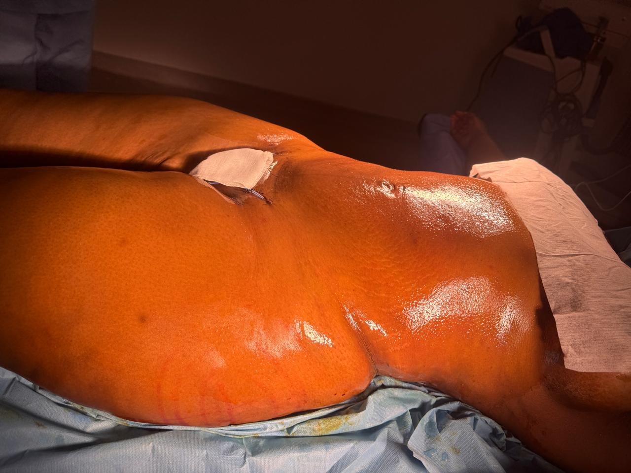 Liposculpture + Renuvion + BBL - Après 6