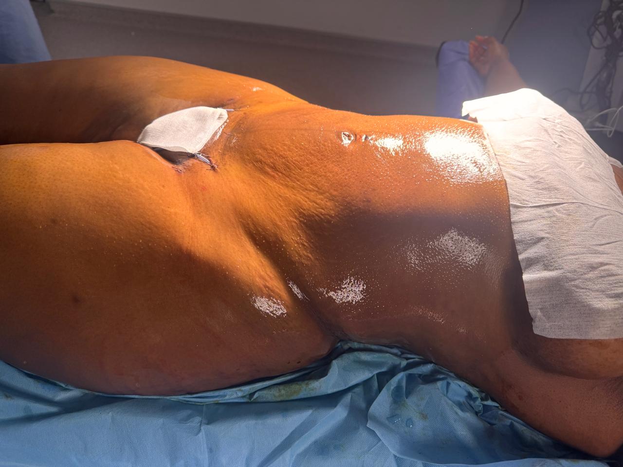 Liposculpture + Renuvion + BBL - Après 2
