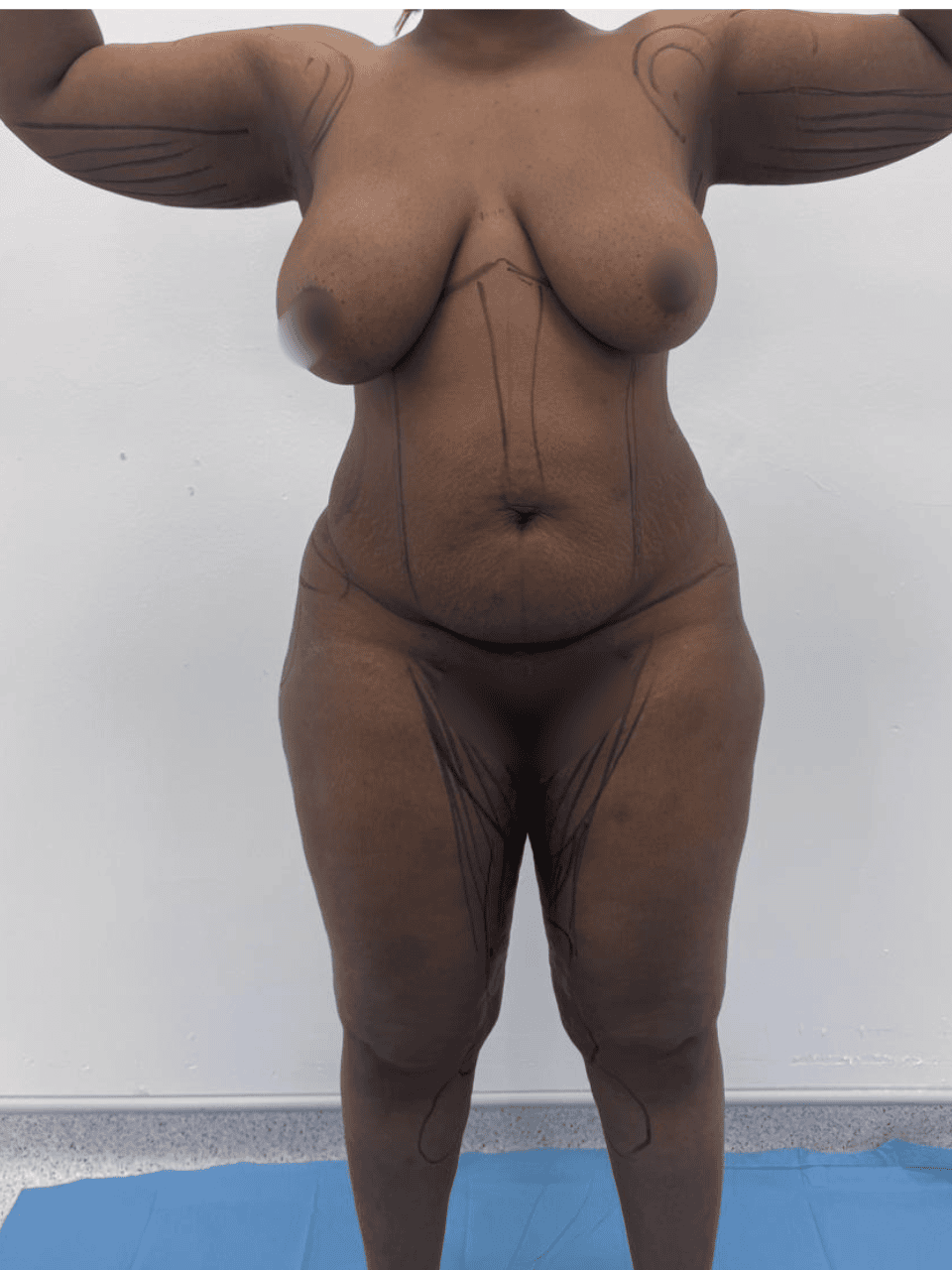 Liposculpture + Renuvion + BBL - Avant 1