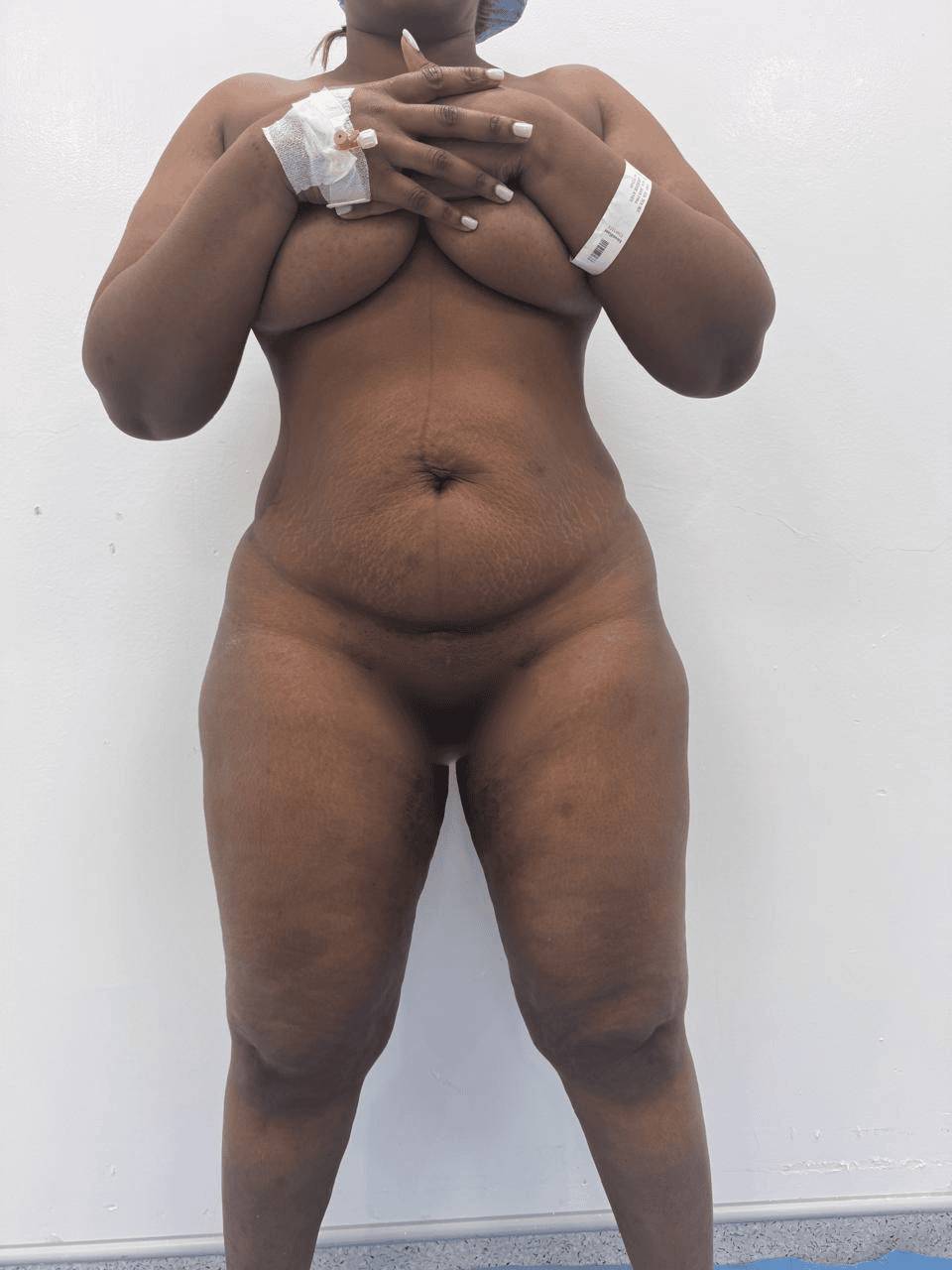 Liposculpture + Renuvion + BBL - Avant 2