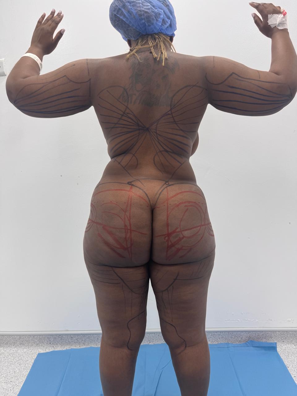 Liposculpture + Renuvion + BBL - Avant 6