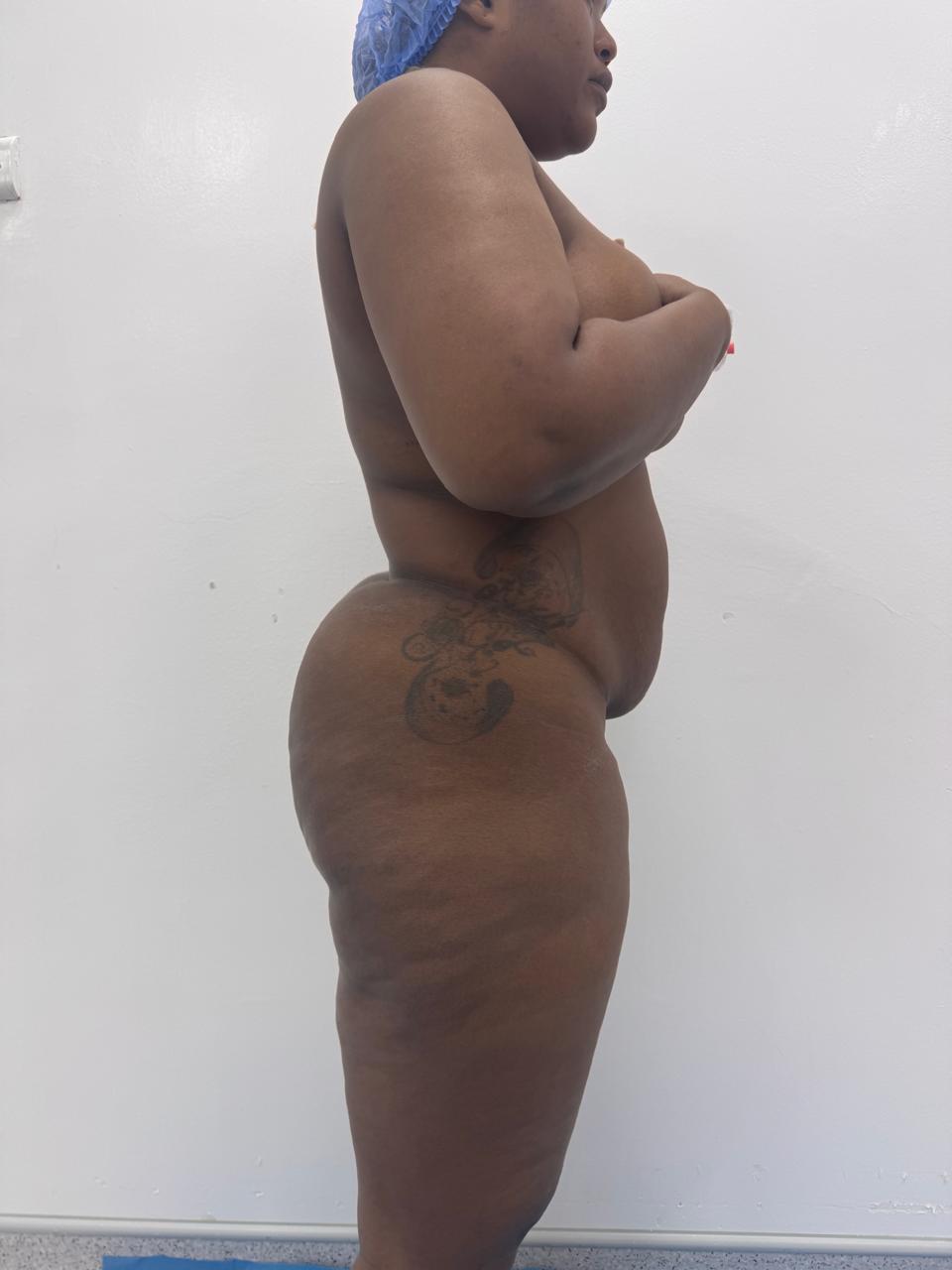 Liposculpture + Renuvion + BBL - Avant 7