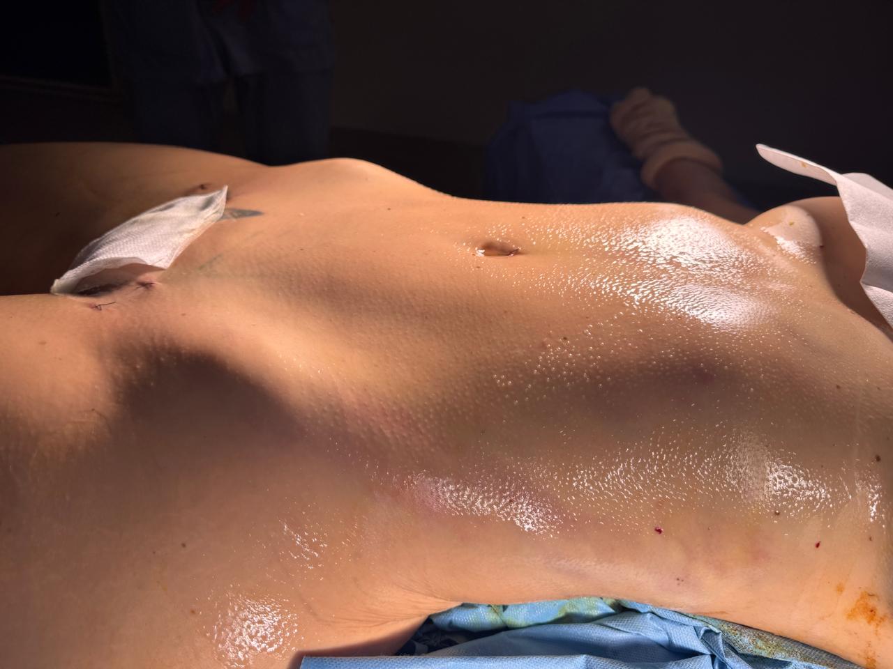 Skinny BBL Liposculpture - Après 4