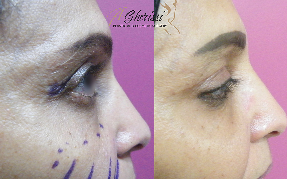 Blépharoplastie vue de profil