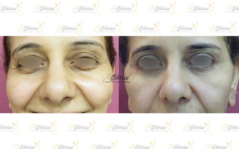 Blépharoplastie vue de face