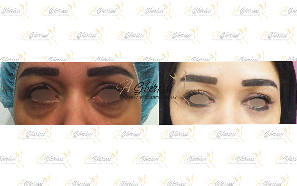 Blépharoplastie vue de face