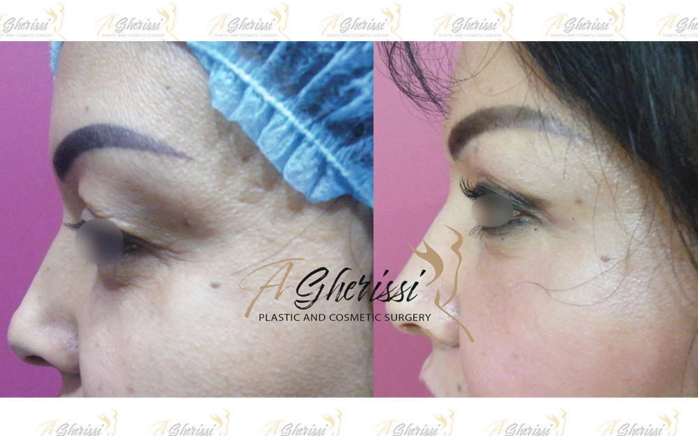 Blépharoplastie vue de profil