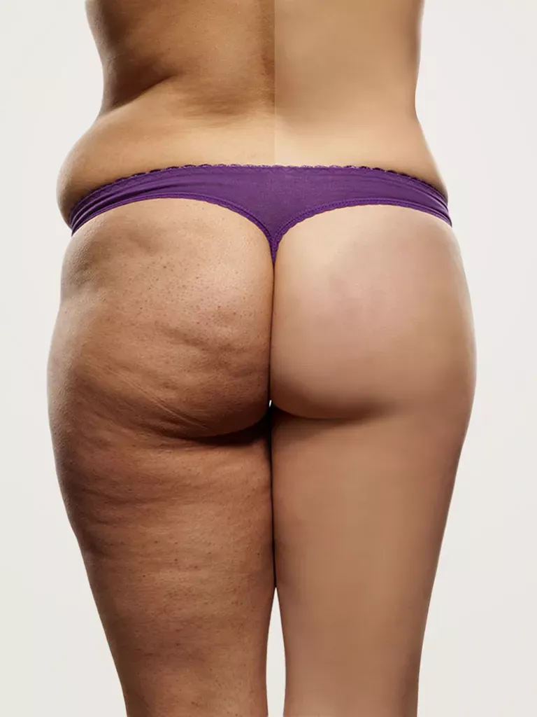 Diamond Incision® : Traitement de la cellulite
