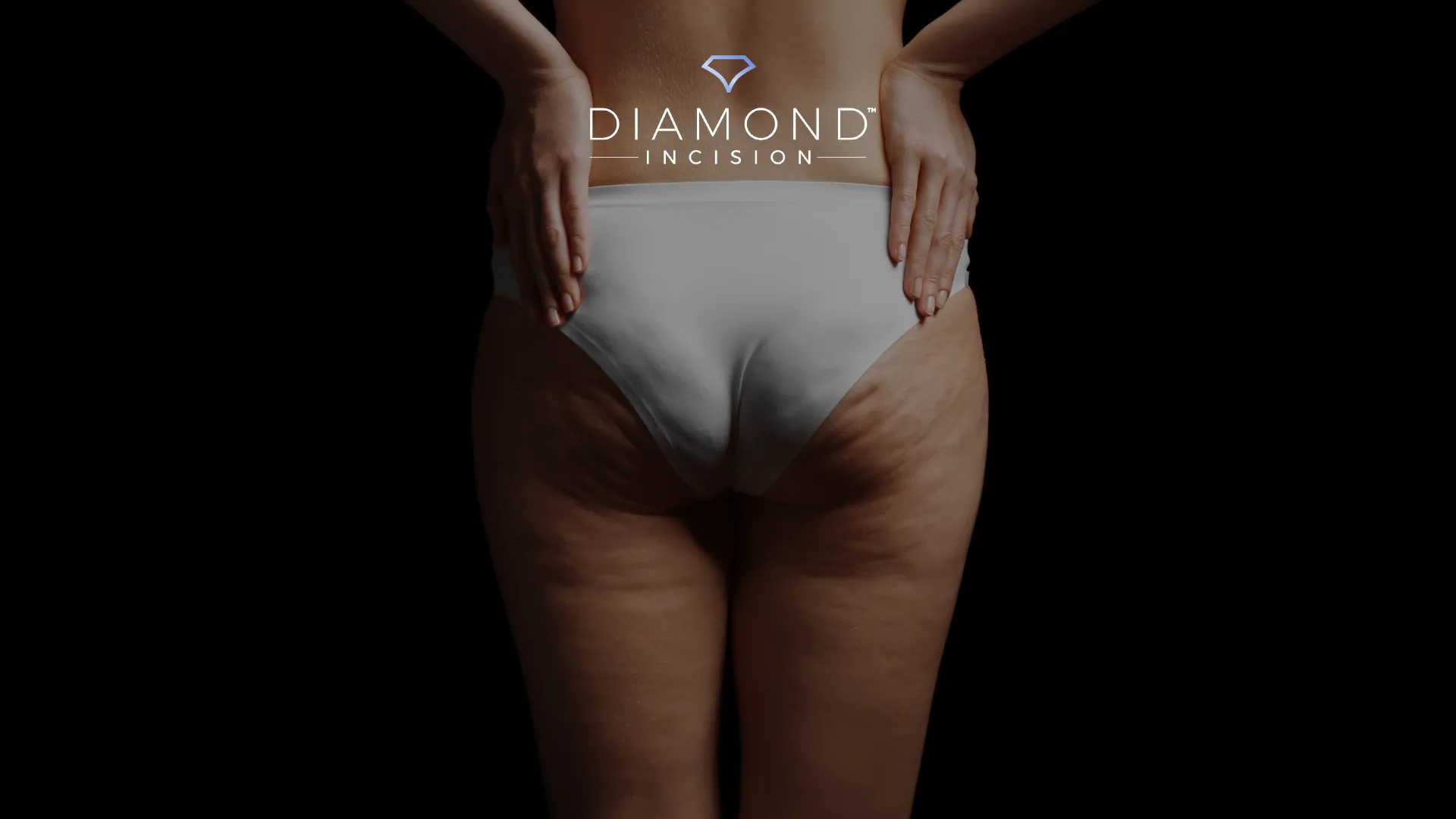 Diamond Incision®