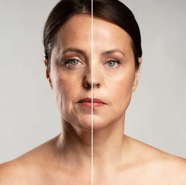 Endolift : Le lifting du visage sans chirurgie invasive