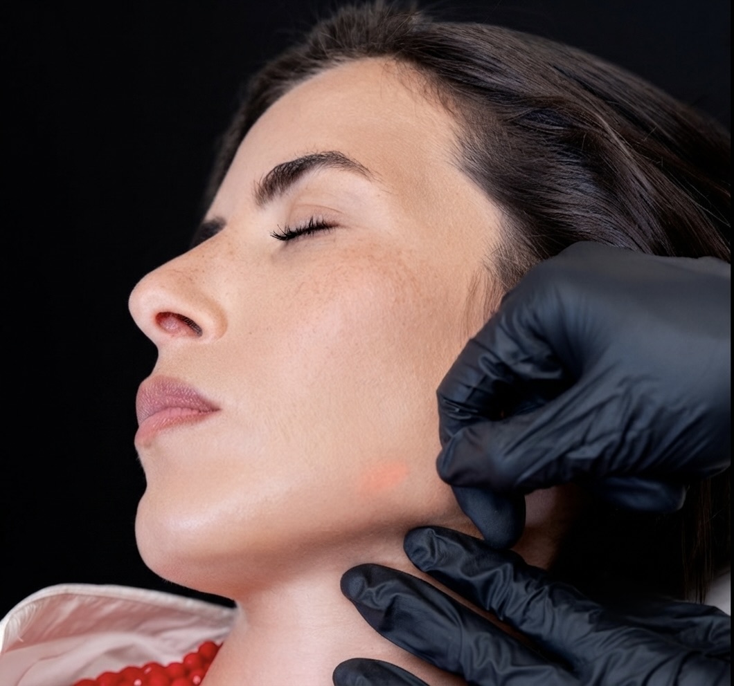 Endolift