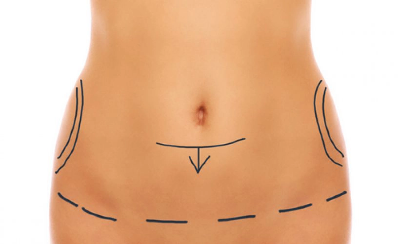 Abdominoplastie