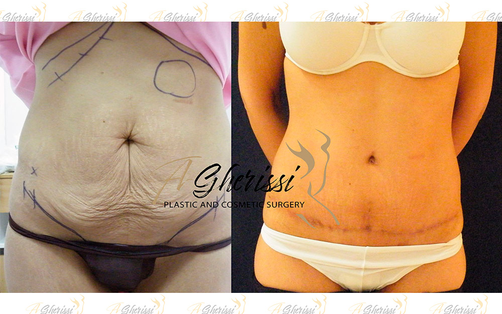 Abdominoplastie vue de face