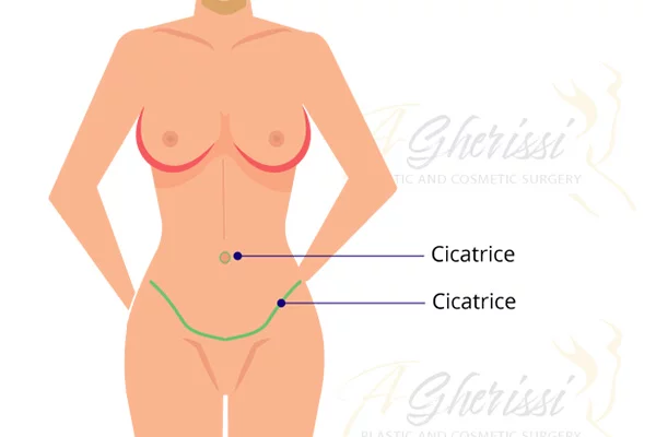 Schéma des cicatrices