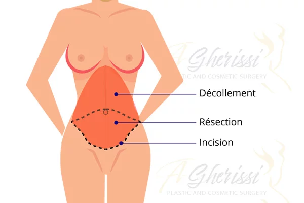 Schéma des incisions