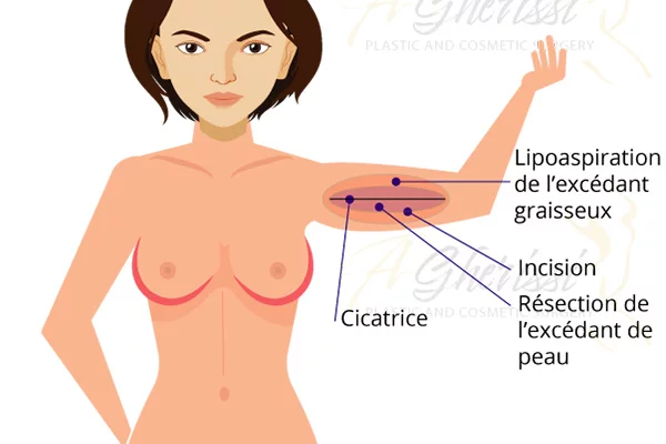 Schéma lifting des bras