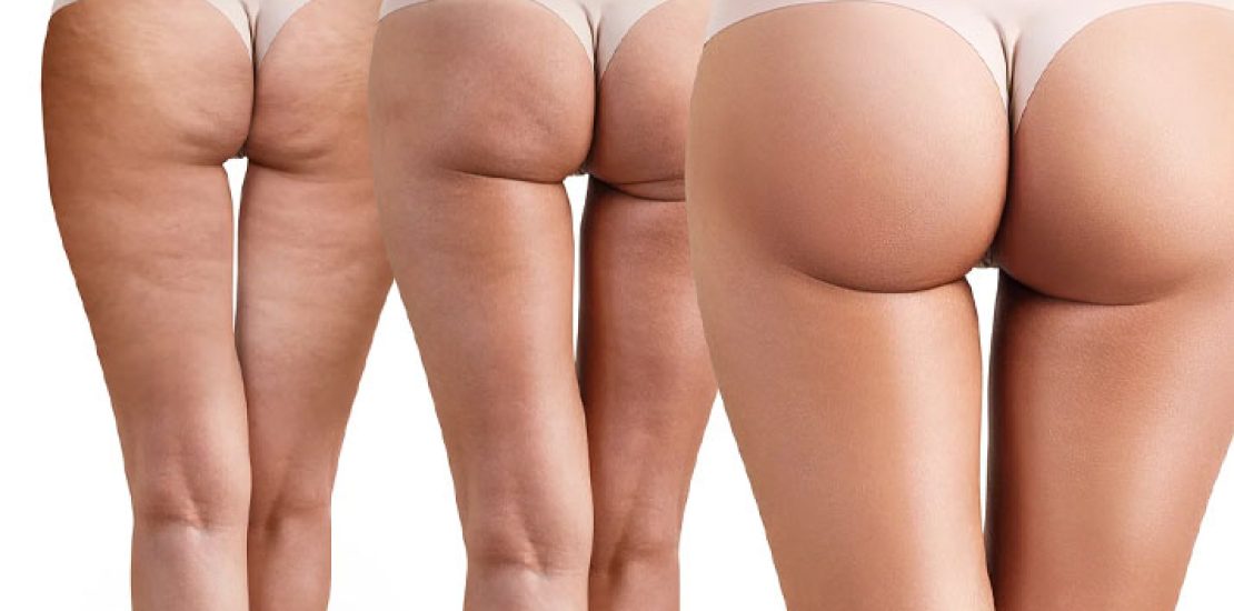 Lifting fesses