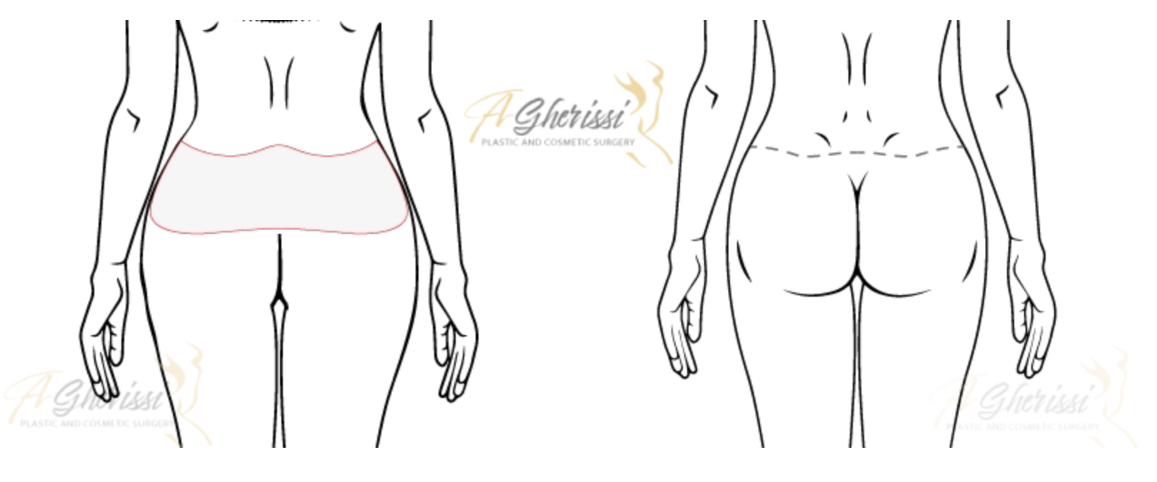Schéma d'un lifting des fesses