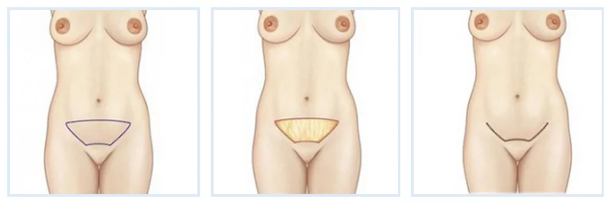 Schéma du mini-lift abdominal